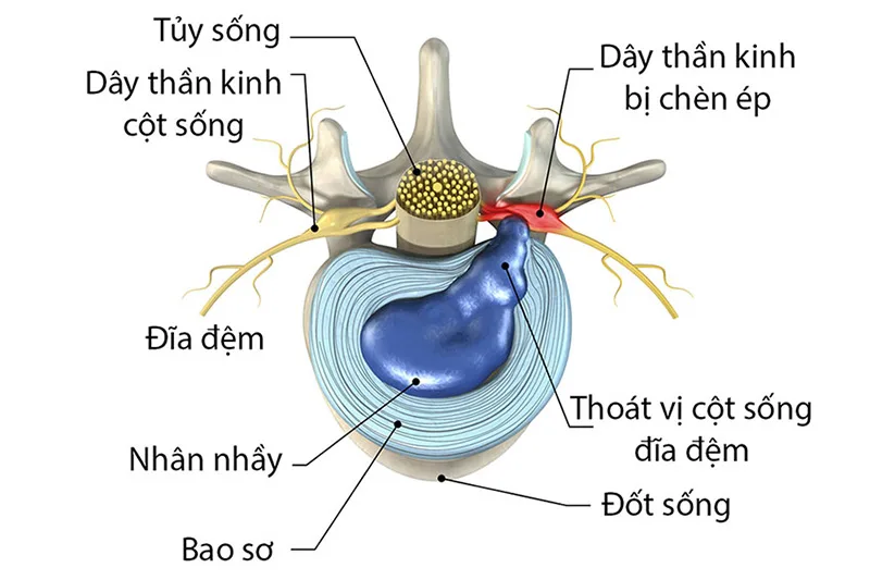 thoát vị đĩa đệm