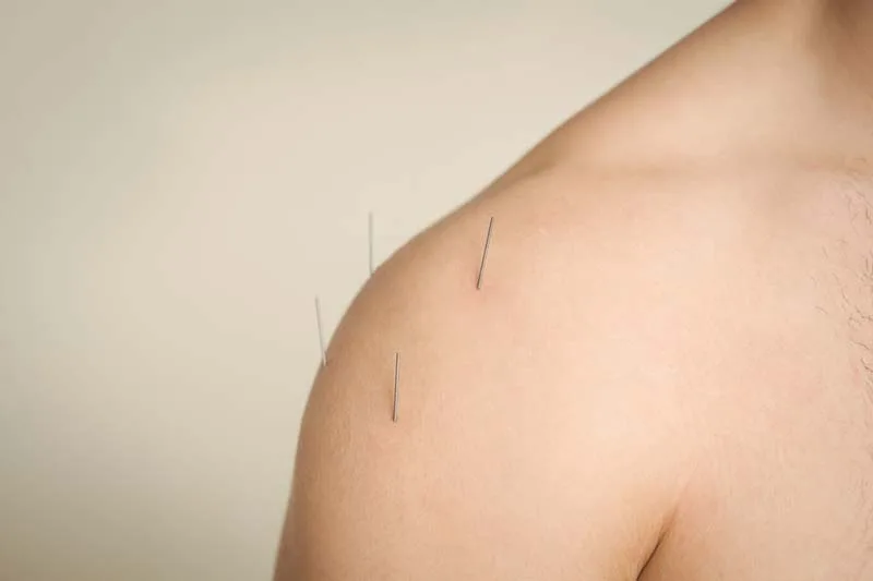 Các kỹ thuật châm cứu phổ biến