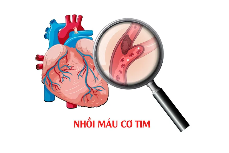 Dấu ấn viêm: hs-CRP, IL-6, và TNF-α
