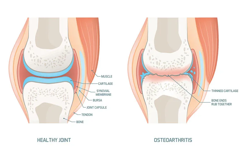 thoái hóa khớp gối